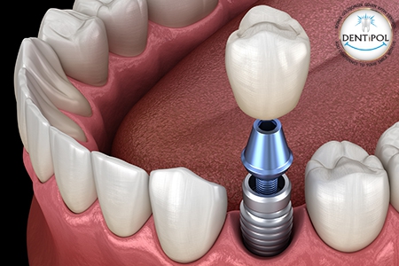 IMPLANT APPLICATION IN THE TREATMENT OF DENTAL DEFICIENCIES