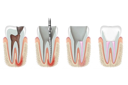 علاج جذور الأسنان - معالجة القنوات